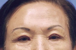 What a remarkable difference! The best endoscopic brow Lift and Upper Eyelid surgery has been performed by Dr. Michael Byun