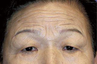 This patient is getting ready for the best Endoscopic Brow Lift and Upper Eyelid Surgery