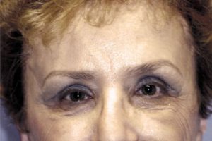 Endoscopic Brow Lift, Upper Eyelids After