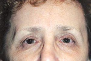 Endoscopic Brow Lift, Upper Eyelids Before