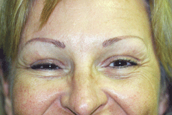 The best endoscopic browlift has been performed by Dr. Michael Byun. Notice the big smile and vibrant tones of the skin.