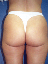 Liposuction can be key for a firmer and more attractive butt. This patient is preparing for the best liposuction procedure by Dr. Byun.