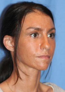 Best Facelift After Pic. This patient is has received the very best facelift by world renowned plastic surgeon Dr. Michael Byun.