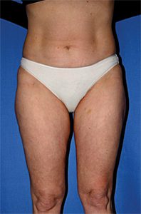 Liposuction After