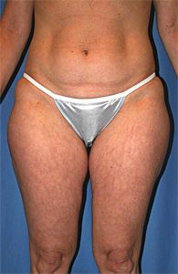 Liposuction Before