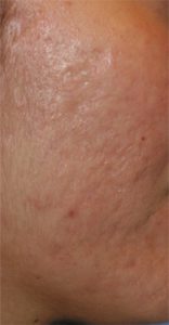 This patient has successfully been treated for acne scarring using Dr. Byun's dermabrasion method