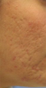 This patient before being treated for acne scarring using Dr. Byun's dermabrasion method