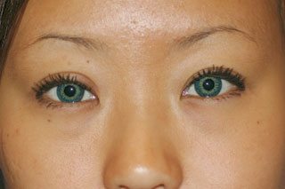 Asian Eyelids After