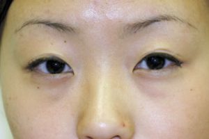 Asian Eyelids Before