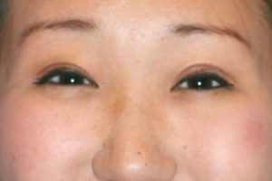 Asian Eyelids After