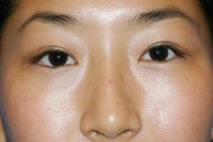 Asian Eyelids After