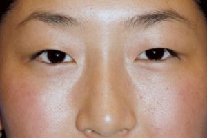 Asian Eyelids Before