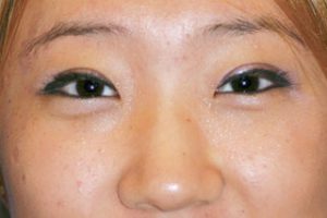 Asian Eyelids After