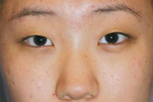 Asian Eyelids Before