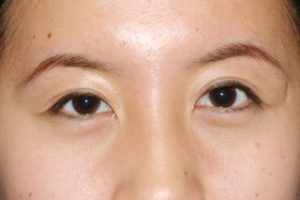 Asian Eyelids After