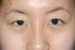 Asian Eyelids Before