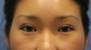 Asian Eyelids After