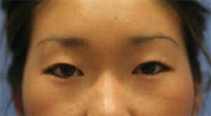 Asian Eyelids Before