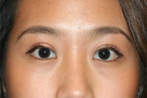 Asian Eyelids After