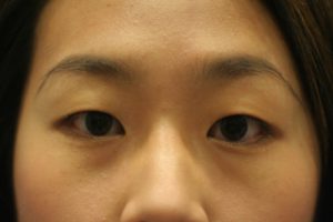 Asian Eyelids Before