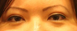 Asian Eyelids After