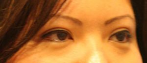 Asian Eyelids After