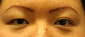 Asian Eyelids Before