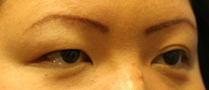 Asian Eyelids Before