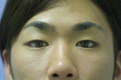 Asian Eyelids Before