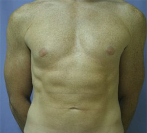 Liposuction After