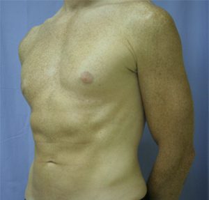 Liposuction After