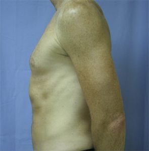 Liposuction After