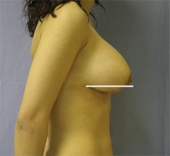 Mammaplasty - Mastopexy