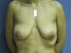 Mammaplasty - Mastopexy