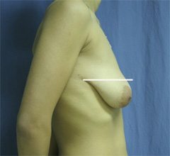 Mammaplasty - Mastopexy