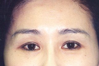 Brow Lift After