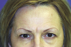 Best Endoscopic Browlift Before Patient Pic