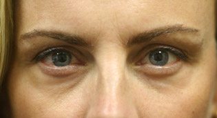 Notice the eyelid folds post best eyelid surgery.