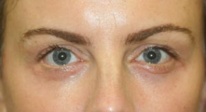 The remarkable results of the best eyelid surgery post 2 months after surgery.