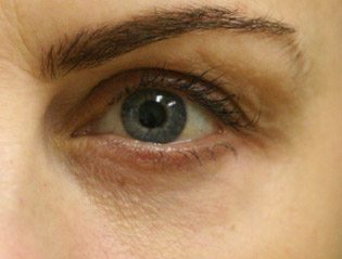 Patient after receiving the best Eyelid surgery post 1 Year