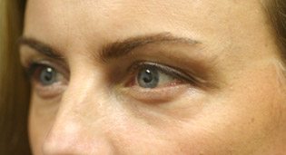 Again, we see the eyelids puffed and angry looking. Pre Surgery for best eyelid surgery.