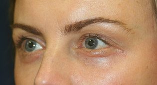 What a remarkable difference 2 months has made after patient received the best eyelid surgery.