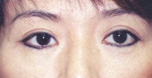 Eyelid After