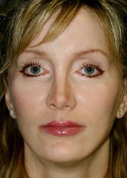 Best Facelift After Pic. This patient has received the very best midface lift and brow lift by world renowned plastic surgeon Dr. Michael Byun.