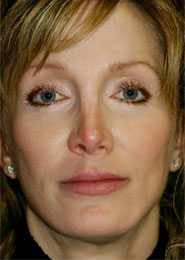 Best Facelift Before Pic. This patient is about to get the very best midface lift and brow lift by world renowned plastic surgeon Dr. Michael Byun.
