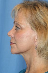 Best Mid face Lift After Pic. This patient has received the very best midface lift, neck lift, jowl lift and lower and upper eyelid surgery by world renowned plastic surgeon Dr. Michael Byun.