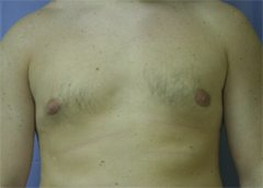 Liposuction After