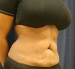 Liposuction After