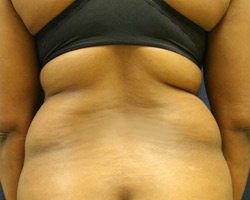 Liposuction Before