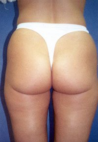 Liposuction Before